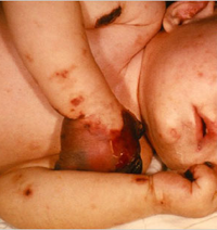 meningococcal3