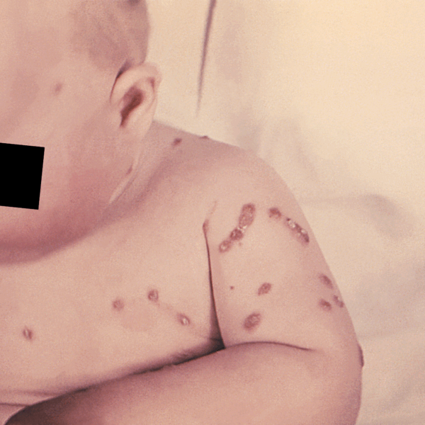 CDC chickenpox photo-14823