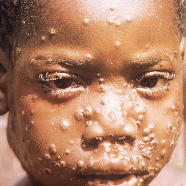 mpox-1